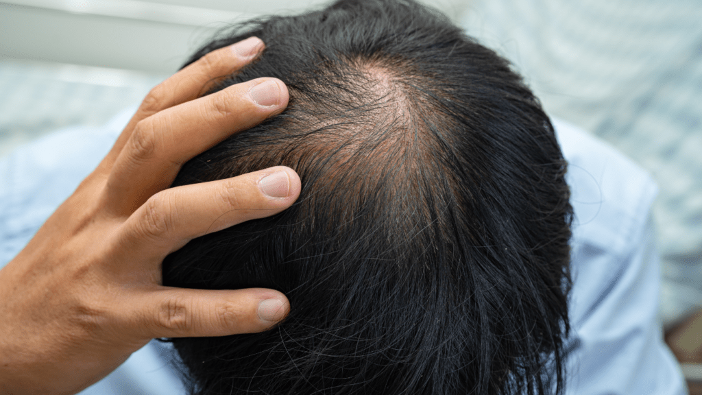 Man's Scalp